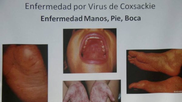 Silence from the Ministry of Health Amid Surge in Hand, Foot, and Mouth Disease Cases in El Salvador — Silencio del Ministerio de Salud ante aumento de casos de síndrome mano-pie-boca en El Salvador