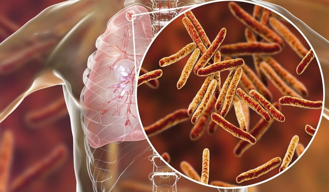 El Salvador reports 6,000 new tuberculosis cases each year, according to the Pulmonology Association — El Salvador reporta 6 mil casos nuevos de tuberculosis cada año, según la Asociación de Neumología