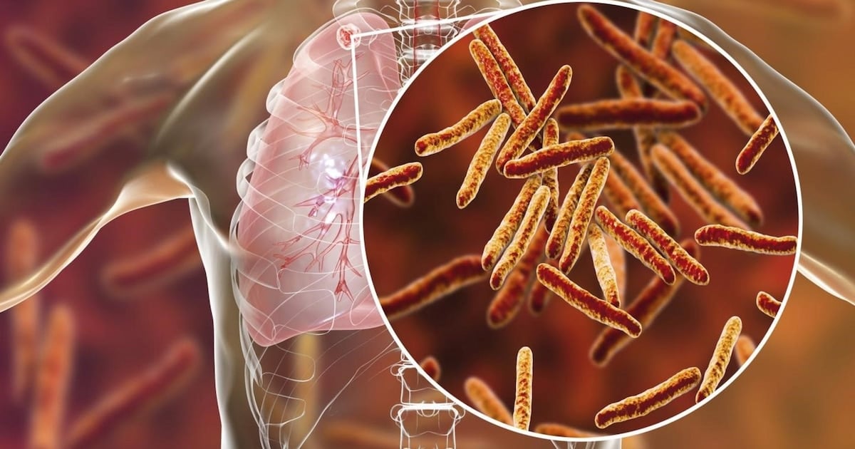 El Salvador reports 6,000 new tuberculosis cases each year, according to the Pulmonology Association — El Salvador reporta 6 mil casos nuevos de tuberculosis cada año, según la Asociación de Neumología