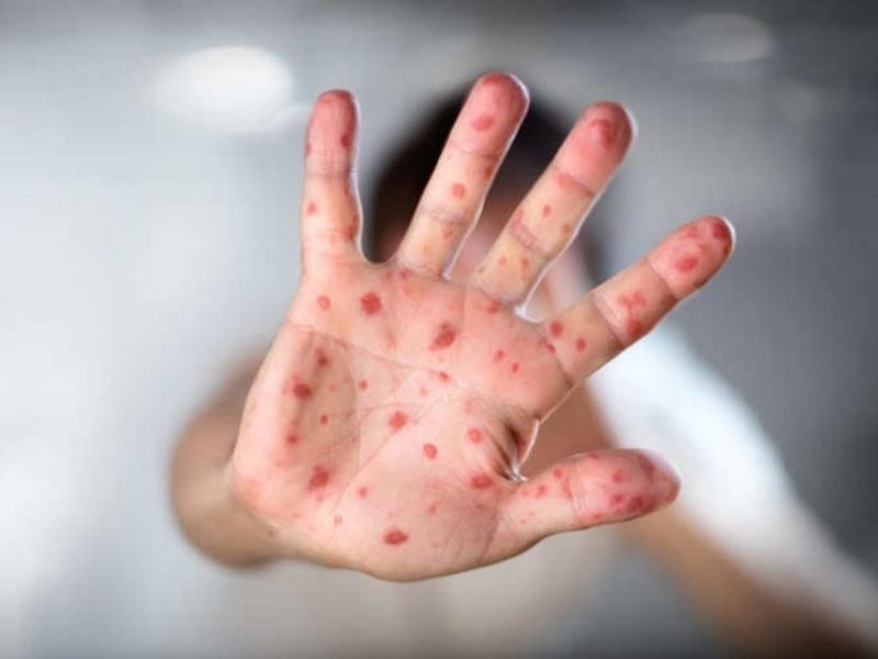 Two new cases raise measles infections in El Salvador to 13, all imported — Dos nuevos casos elevan a 13 los contagios de sarampión en El Salvador, todos importados