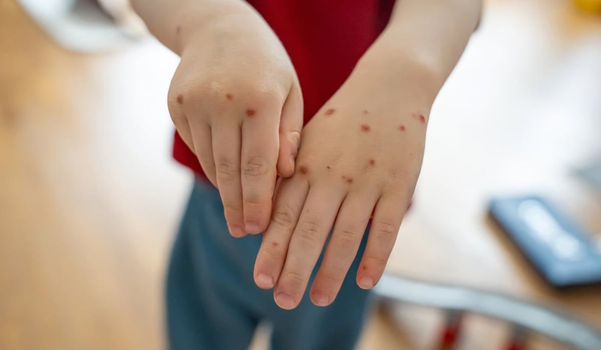 Measles cases rise to 39 — Aumentan a 39 los casos de sarampión