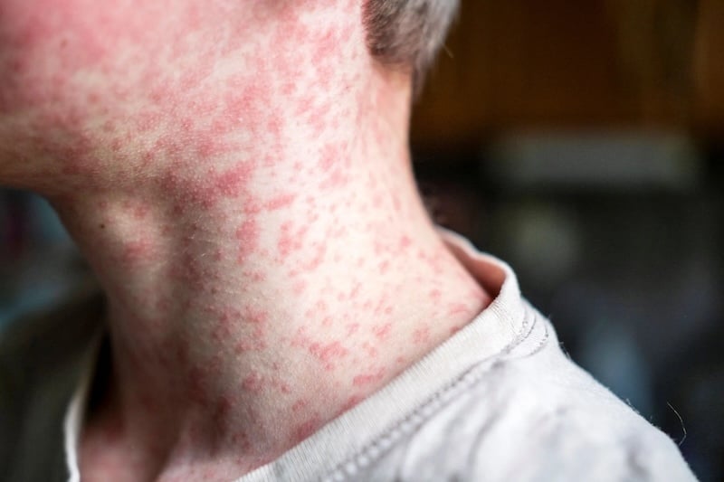 Measles cases in El Salvador rise to 53 as Health Ministry identifies children and districts with infections — Casos de sarampión en El Salvador suben a 53 mientras Salud identifica a niños y distritos con contagios