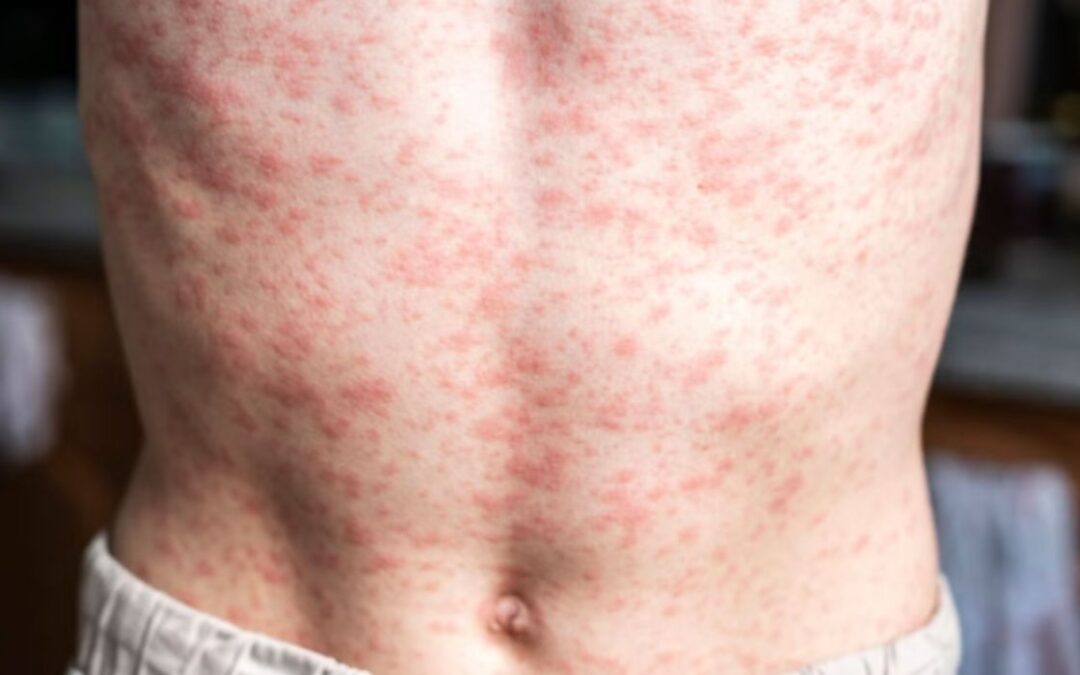 53 measles cases in El Salvador raise concern amid lack of official information — 53 casos de sarampión en El Salvador preocupan ante falta de información oficial