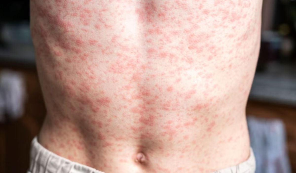 53 measles cases in El Salvador raise concern amid lack of official information — 53 casos de sarampión en El Salvador preocupan ante falta de información oficial