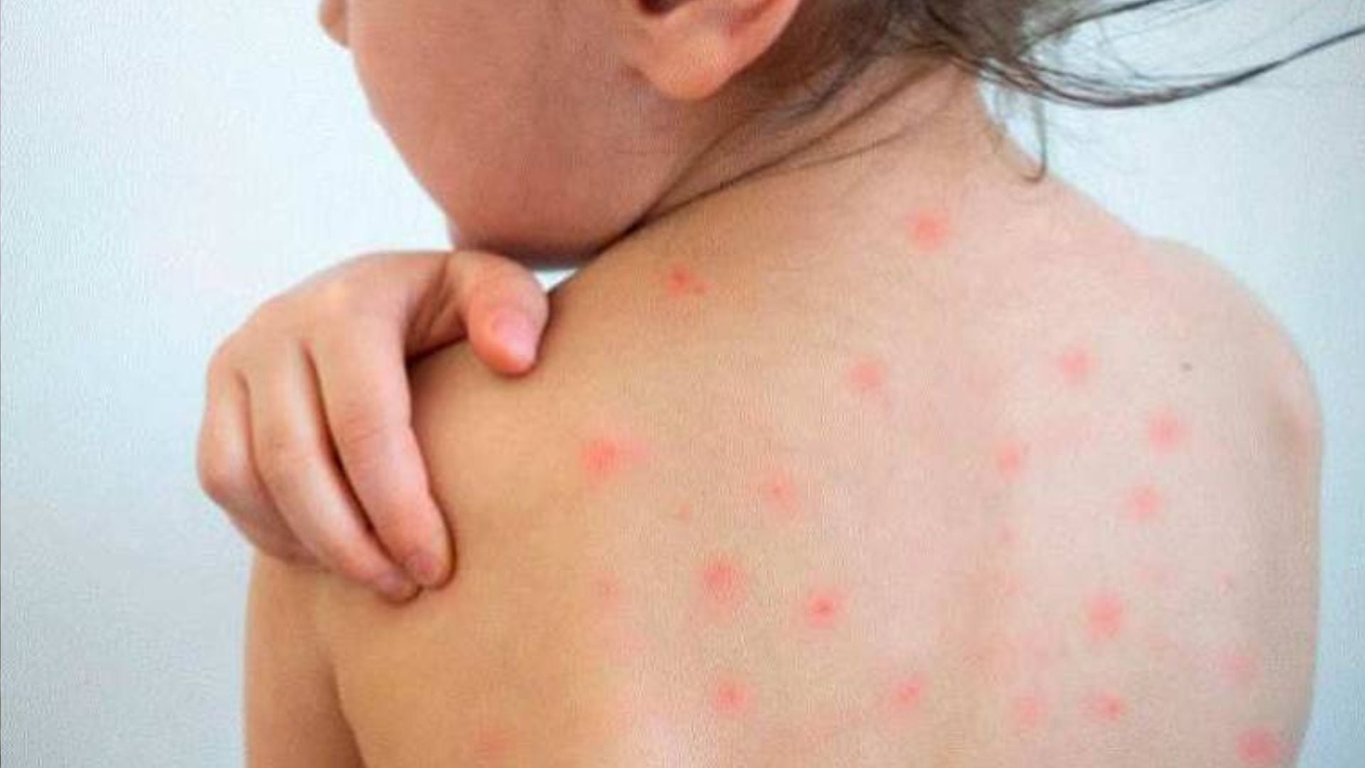 El Salvador’s measles cases remain at 58, but eruptive fever consultations rise to 2,000 — El Salvador mantiene 58 casos de sarampión, pero aumentan a 2,000 consultas por fiebre eruptiva